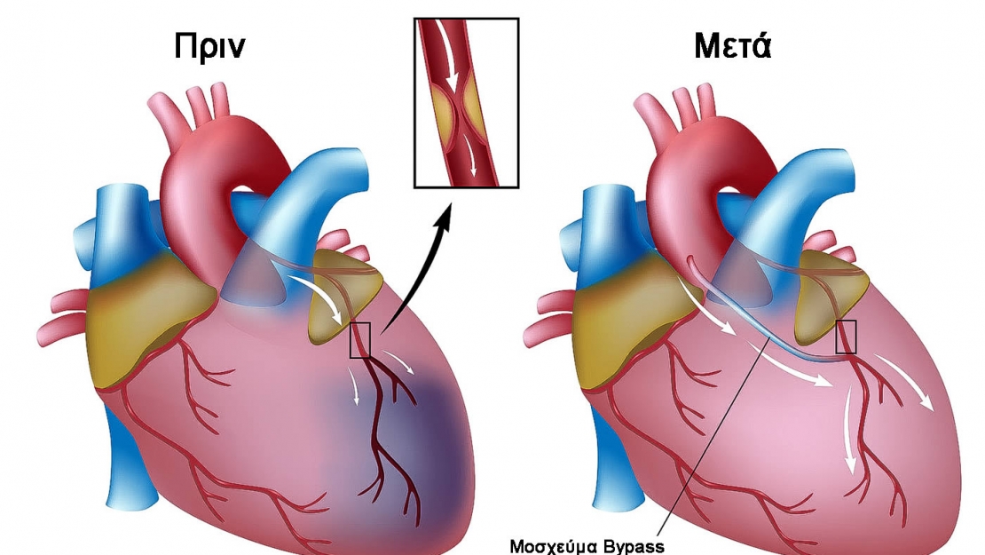 Aoρτοστεφανιαία Παράκαμψη ή by-pass